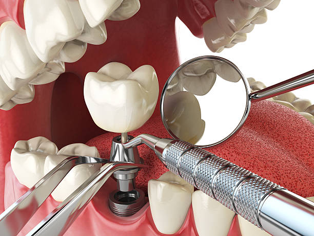 Best Emergency Tooth Extraction in Rose Hill, VA